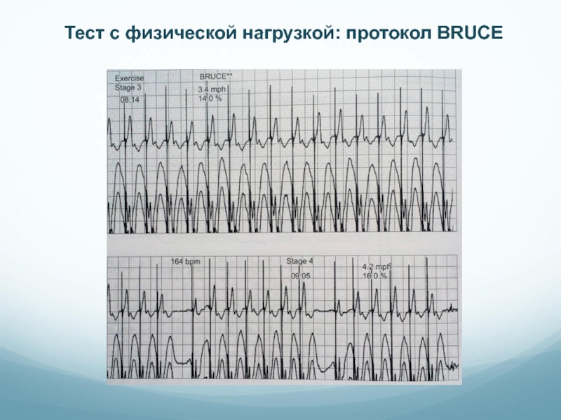 Протокол брюса. Тест с физической нагрузкой. Тредмил протокол по Брюсу. Протокол Брюса тредмил тест.