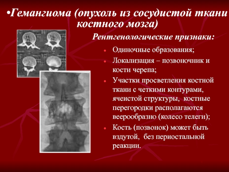 Воспаление костного мозга сустава. Гемангиома костей черепа рентген. Опухоли сосудистой ткани.