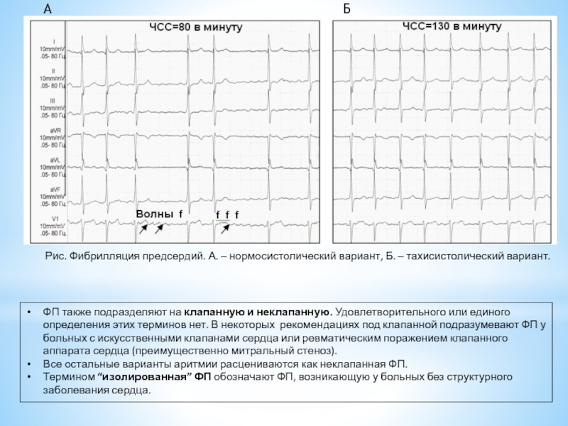 Карта вызова смп фибрилляция предсердий тахисистолическая форма