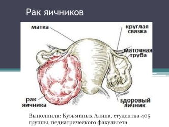 Рак яичников