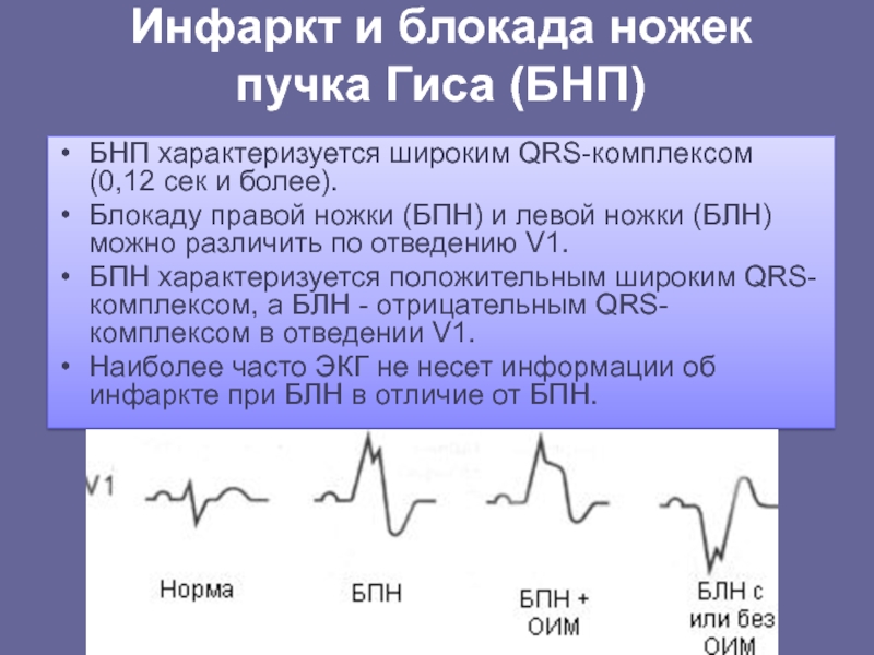 Инфаркт и блокада ножек пучка Гиса (БНП) БНП характеризуется широким QRS-комплексом