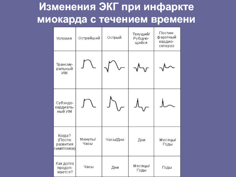 Изменения ЭКГ при инфаркте миокарда с течением времени