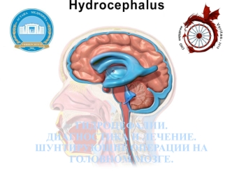 Гидроцефалии. Диагностика и лечение. Шунтирующие операции на головном мозге