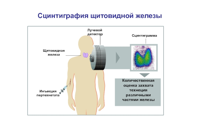 Сцинтиграфия щитовидной железы картинки