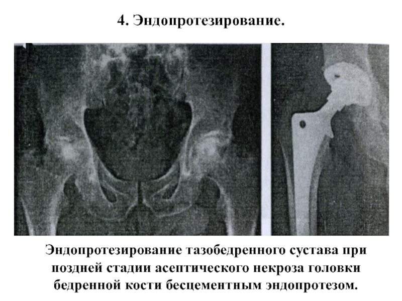 Некроз тазобедренного сустава 3 степени лечение без операции фото