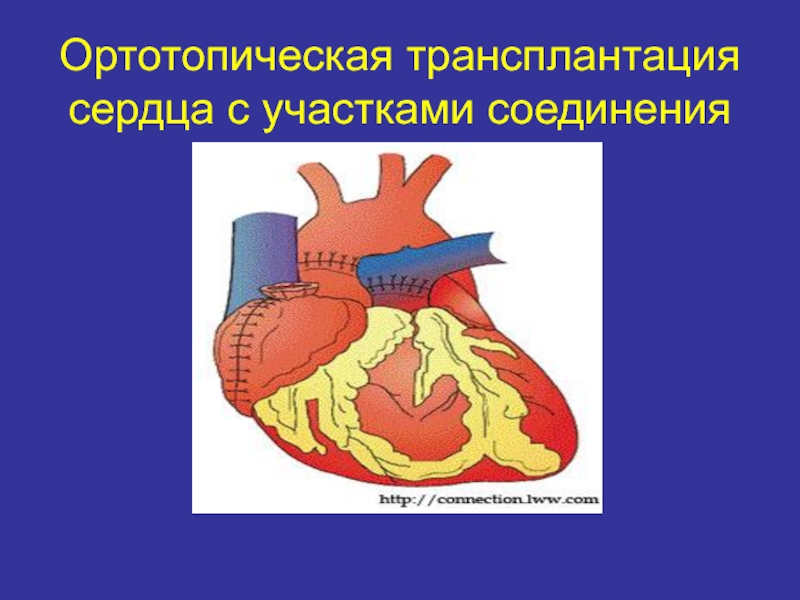 Трансплантация сердца презентация