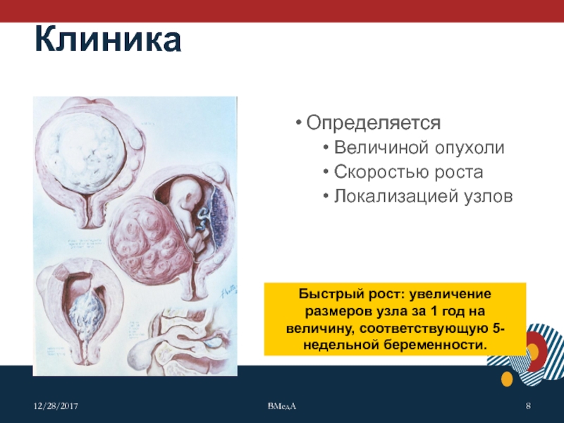 Субмукозная матка. Субмукозная миома клиника. Клиника родившегося субмукозного узла. Субмукозная миома мкб 10. Субмукозная миома матки мкб 10.