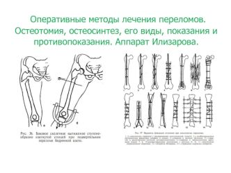 Оперативные методы лечения переломов. Остеотомия, остеосинтез, его виды, показания и противопоказания. Аппарат Илизарова