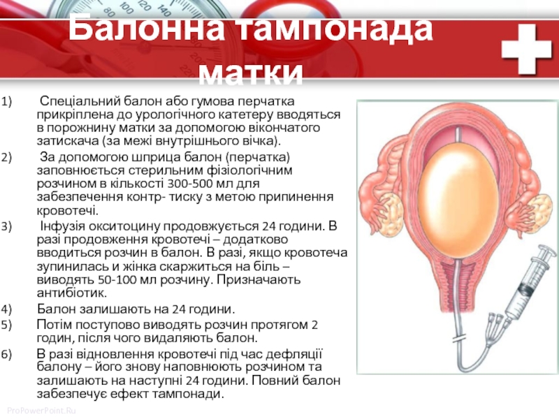 Баллонная тампонада матки презентация