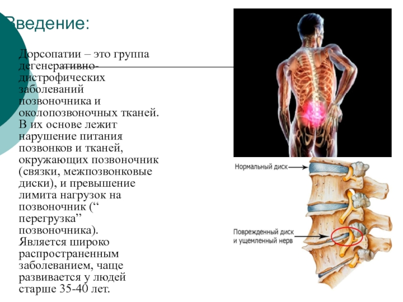 Дегенеративно дистрофические заболевания позвоночника презентация