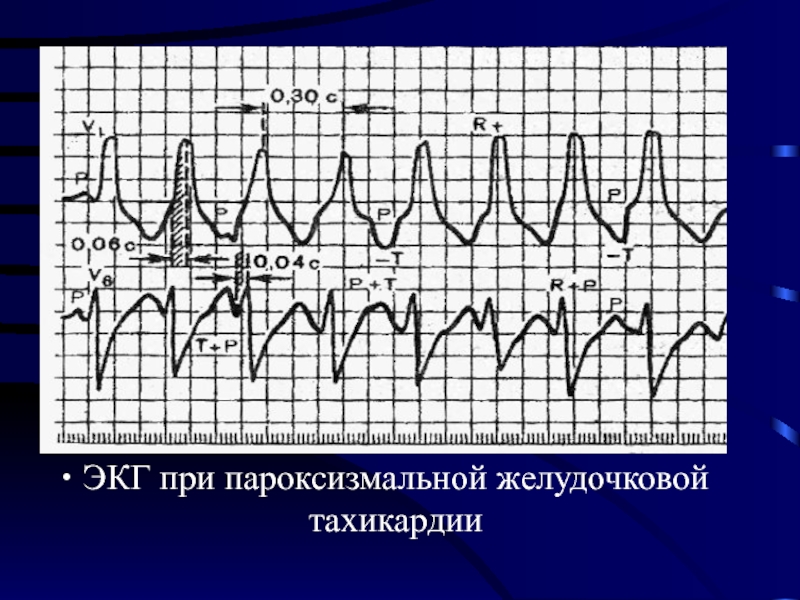 Перегрузка желудочков на экг