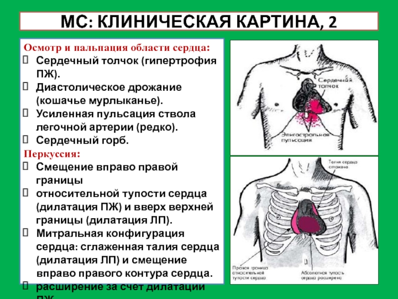 Видна пульсация. Ревматизм сердца пальпация. Ревматизм аускультация. Папальции области сердце. Пальпация области сердца.