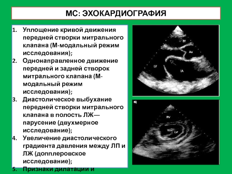 Приобретенные пороки митрального клапана