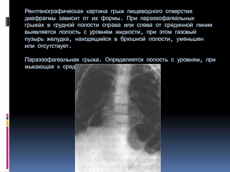 Презентация на тему диафрагмальные грыжи