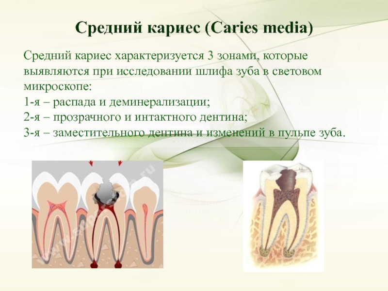 Кариес дентина презентация