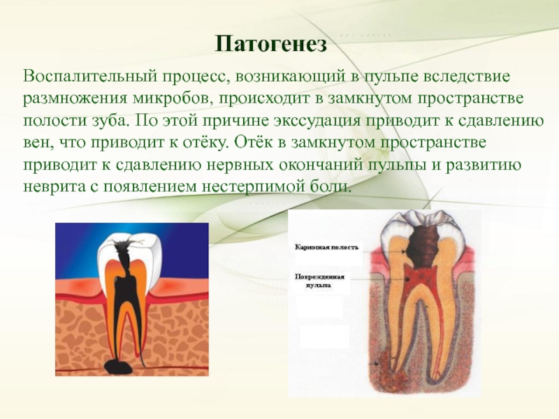 Заболевания зубов и полости. Djcgfkbntkmysq ghjwtccc pe, f. Воспалительный процесс зуба. Воспалительный процесс в пульпе зуба и периодонте. В пульпе зуба и в периодонте может развиться воспаление.