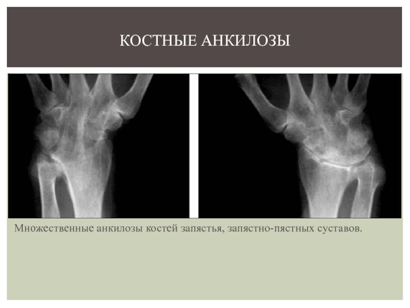 Рентгенологическая картина костного анкилоза внчс характеризуется