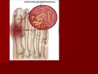 Подагра. Патогенез подагры