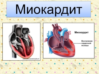 Миокардит. Этиология. Патогенез