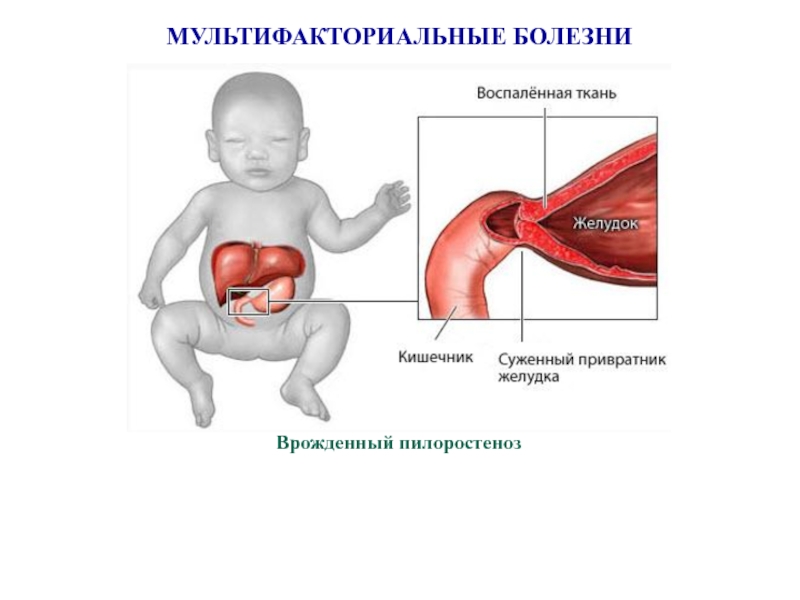 Схема харриса мультифакторные заболевания