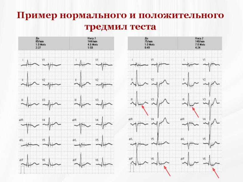 Экг после. Тредмил тест при стенокардии. Тредмил тест нормальные показатели. ЭКГ велоэргометрия стенокардия. Тредмил тест Результаты расшифровка.