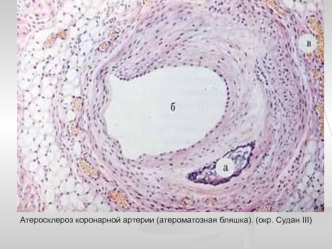 Атеросклероз коронарной артерии