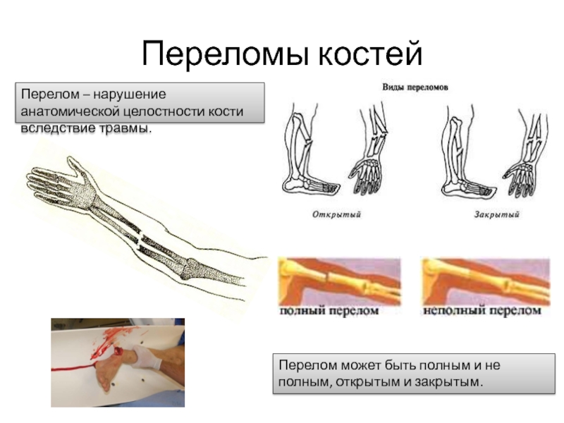 Кости закрыли. Перелом — это нарушение целостности кости. Перелом кости - частичное или полное нарушение целостности кости. Открытый и закрытый перелом.