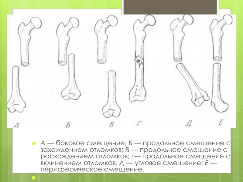 Смещение отломков кости. Угловое смещение костных отломков. Поперечный перелом со смещением отломков по ширине. Косой перелом со смещением отломков по длине и с расхождением схема. Косой перелом со смещением отломков по длине и с расхождением.