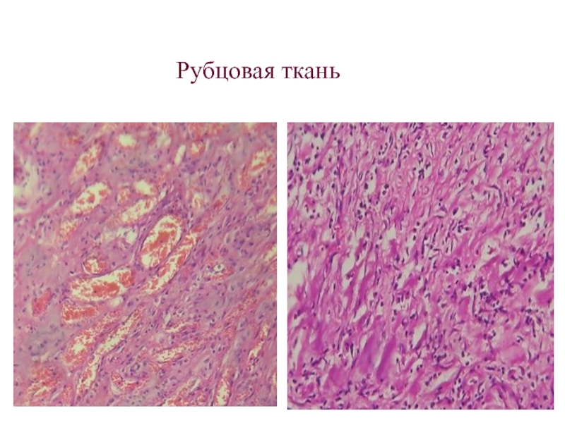 Грануляционная ткань. Язвенный колит соединительная ткань.