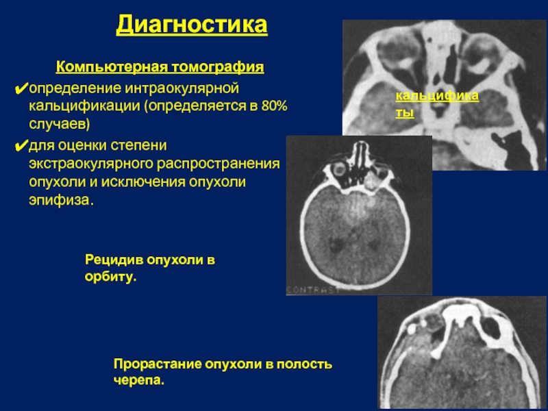 Компьютерная томография определяет