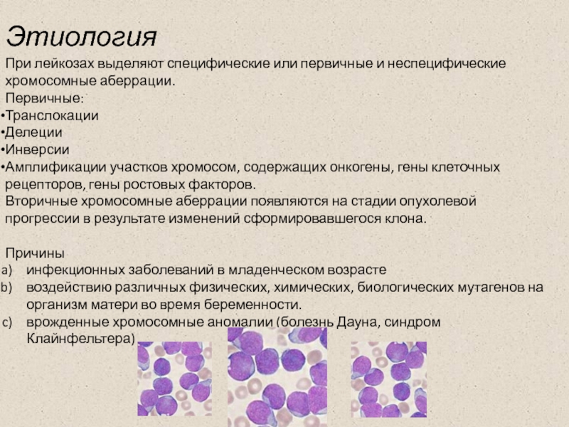 Острый лимфолейкоз презентация