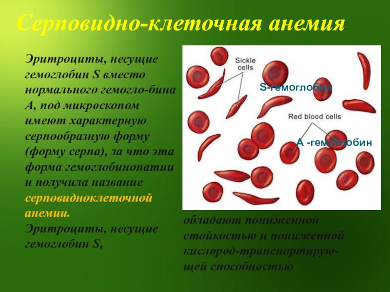 Серповидно клеточная анемия картинки