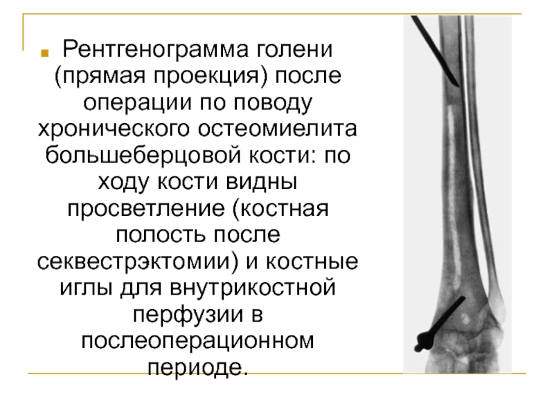 Гематогенный остеомиелит операция. Гематогенный остеомиелит большеберцовой кости голени. Секвестрэктомия при хроническом остеомиелите. Экскохлеация костных полостей.