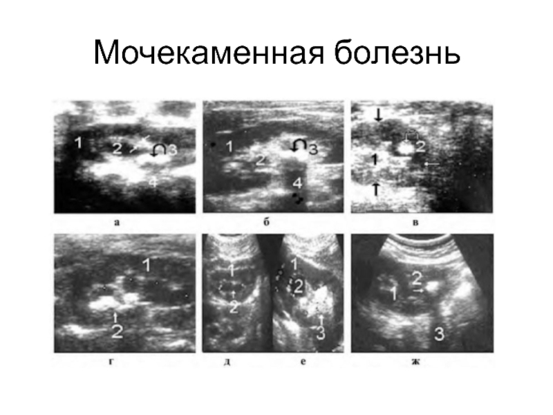 Узи почек и мочевого