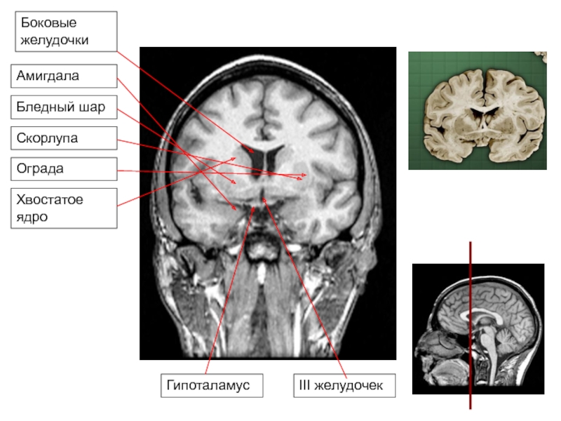 Расширения передних рогов. 3 Желудочек головного мозга кт. Боковые желудочки головного мозга кт. Желудочки головного мозга кт анатомия. Третий желудочек головного мозга кт.