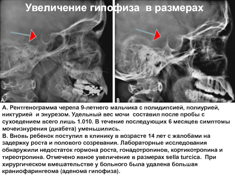 Размер гипофиза. Рентген турецкого седла опухоль гипофиза. Турецкое седло рентген описание. Аденома гипофиза рентген черепа. Опухоль турецкого седла рентген.