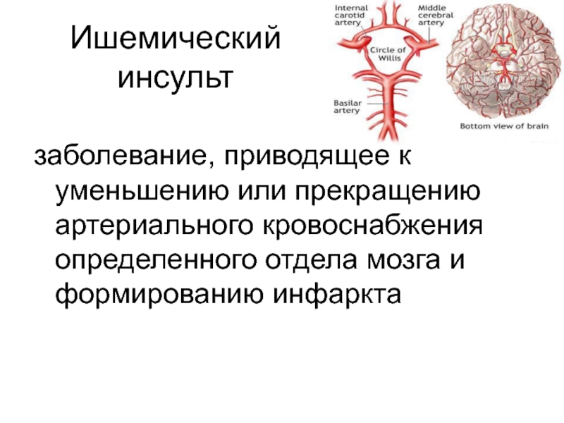 Что такое ишемический инсульт головного мозга. Ишемический инсульт схема. Ишемический инсульт кратко.