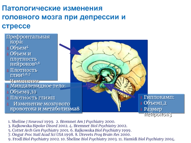 Корковые изменения головного мозга. Изменения в мозге при депрессии. Активность мозга при депрессии.