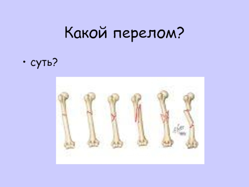 Перелом это какой вред здоровью. Самый опасный перелом костей. Какие переломы были в стране. Какой вид перелома опасно всего.