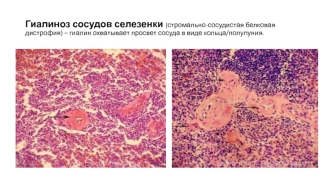 Гиалиноз сосудов селезенки (стромально-сосудистая белковая дистрофия)