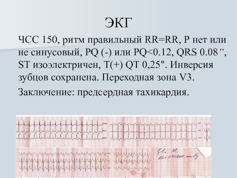 Заключение экг. ЭКГ заключение синусовый. Заключение в ЭКГ несинусовый ритм. Заключение по ЭКГ ритм синусовая тахикардия. ЧСС 150 на ЭКГ С синусовым ритмом.