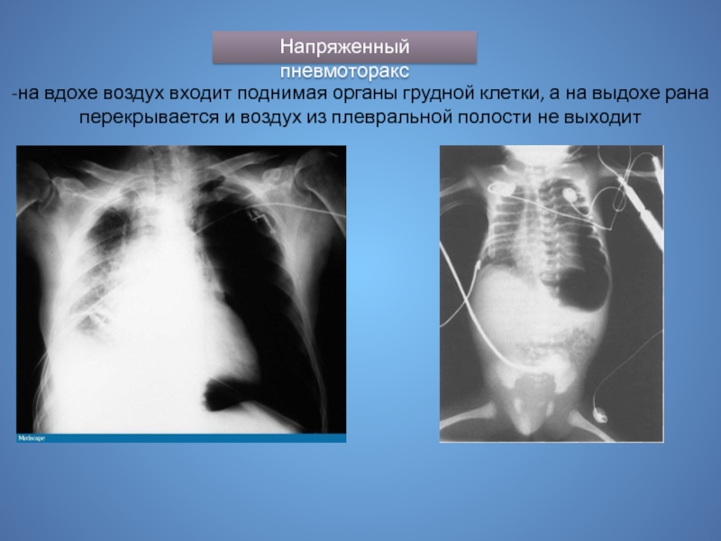 Презентация повреждения грудной клетки