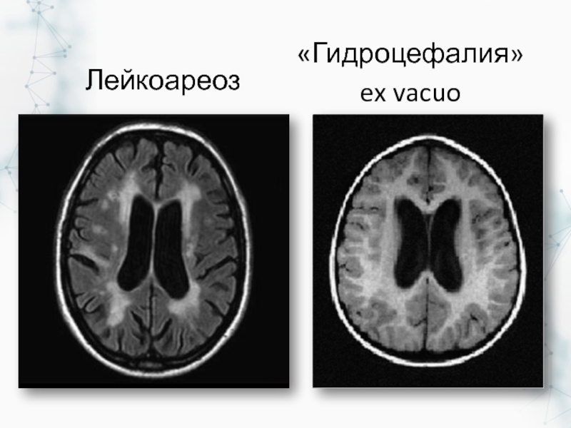 Лейкоареоз головного. Лейкоареоз мрт. Перивентрикулярный лейкоареоз мрт. Зоны лейкоареоза мрт. Лейкоареоз головного мозга мрт.