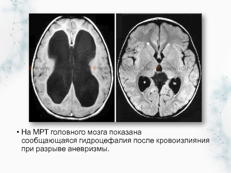 Картина наружной гидроцефалии головного мозга