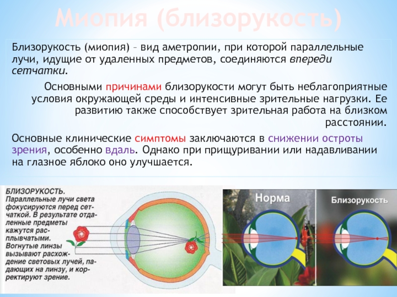 При близорукости изображение