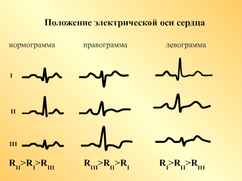 Эос экг картинки