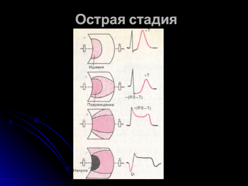 Острая стадия. Стадии инфаркта на ЭКГ. Острейшая стадия им. Острейшая стадия Окс.