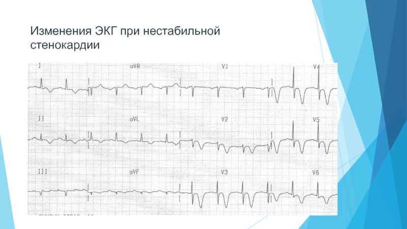 Нестабильная стенокардия на экг фото