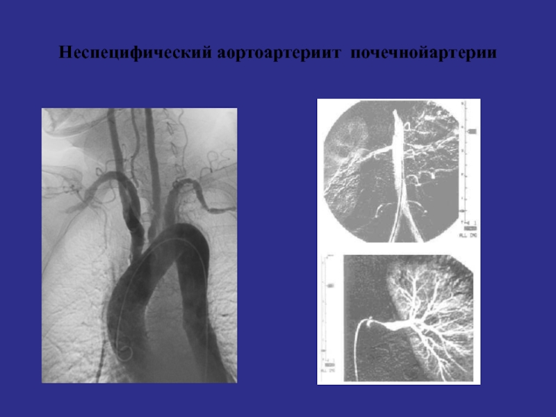 Неспецифический аортоартериит презентация