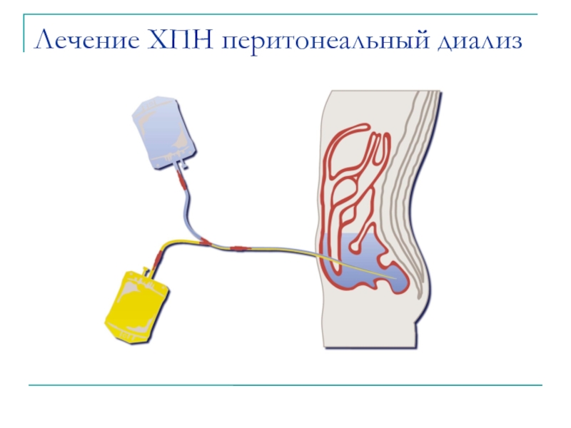 Перитонеальный диализ. Гемодиализ и перитонеальный диализ. Схема перитонеального диализа. Показания для проведения перитонеального диализа. Перитонеальный диализ у детей.